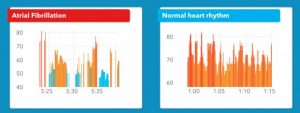سنسور ضربان قلب اپل واچ نارسایی های قلبی را با دقتی بسیار بالا تشخیص می‌دهد